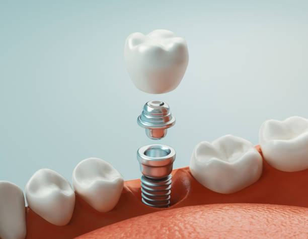 Dental Implants Surgery Houston Texas